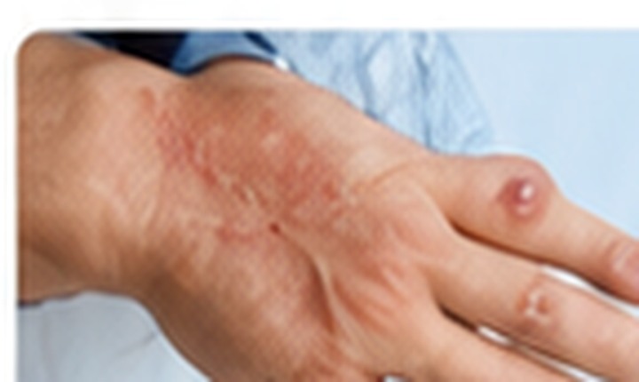 Burn and trauma reconstruction