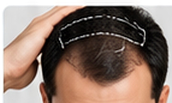 Hair transplant consultation
