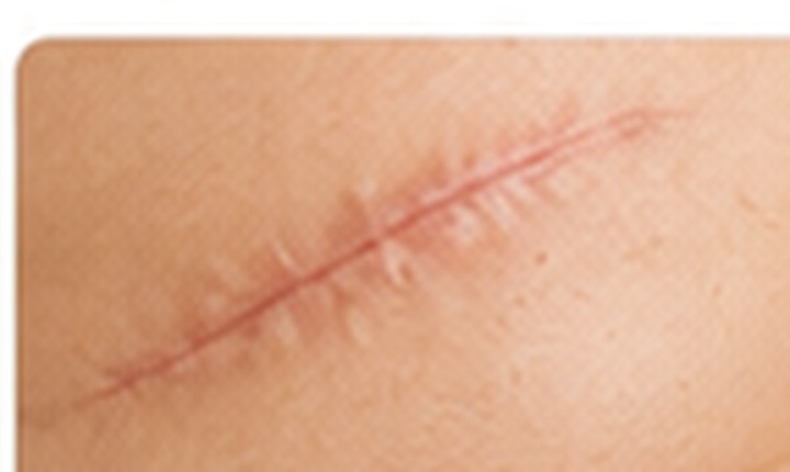 Scar revision and keloid care